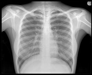 chest x-ray